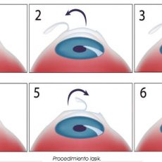 Cirugía Lasik