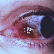 Sida y ojo