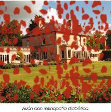 Retinopatía Diabética