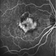 Angiografía Retinal con Fluoresceina