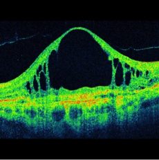 OCT macular